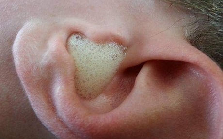 Как убрать серную пробку из уха