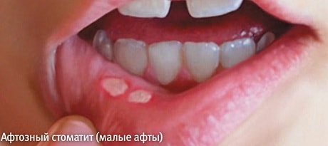 Почему появляются язвочки на губе