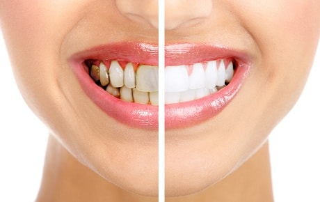 Накопления на зубах как лечить