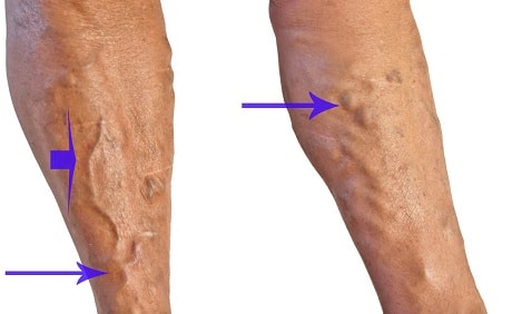 Причины атеросклероза сосудов ног