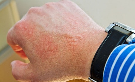 Аллергические пятна на коже рук
