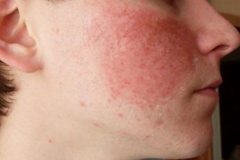 Лечение кожной аллергии