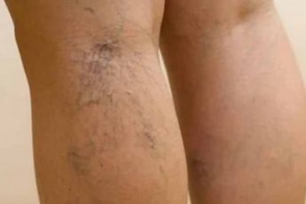 Симптомы тромбофлебита вен на ногах