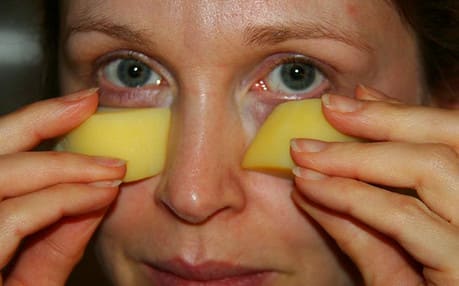Как лечить мешки под глазами картофелем