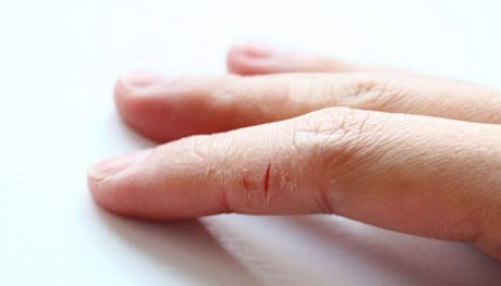 Чем лечить трещины на пальцах