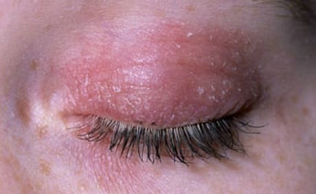 Аллергический дерматит на веках глаз