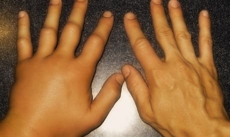 Симптомы и лечение артрита суставов пальцев рук медикаментозными и народными средствами