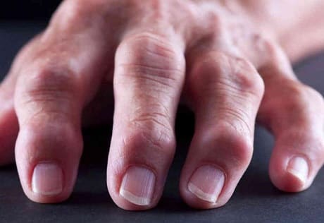 Первые симптомы артрита пальцев