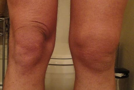 Как лечить коленный бурсит