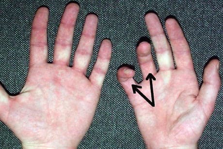 Онемение и покалывание пальцев рук