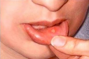 Как и чем лечить белые язвочки во рту