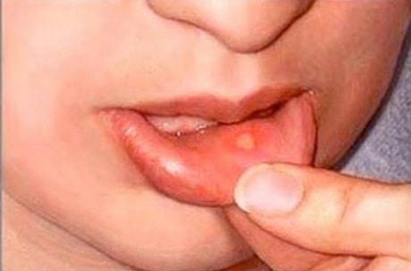 Как и чем лечить белые язвочки во рту