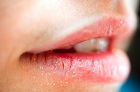 Как лечить хейлит на губах