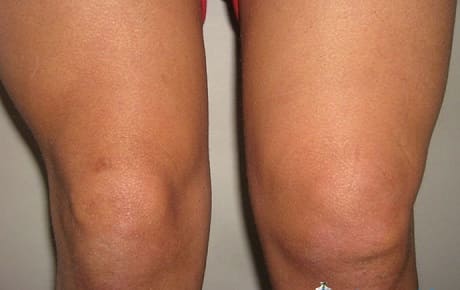 Повреждение коленного мениска