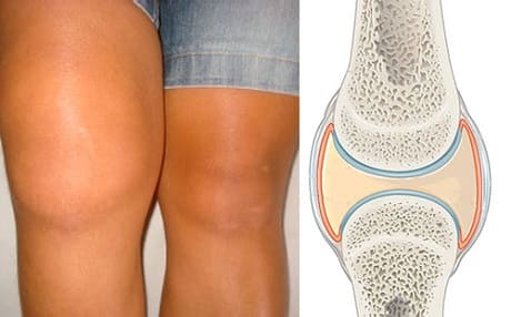Как лечить синовит коленного сустава