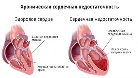 Лечение хронической сердечной недостаточности